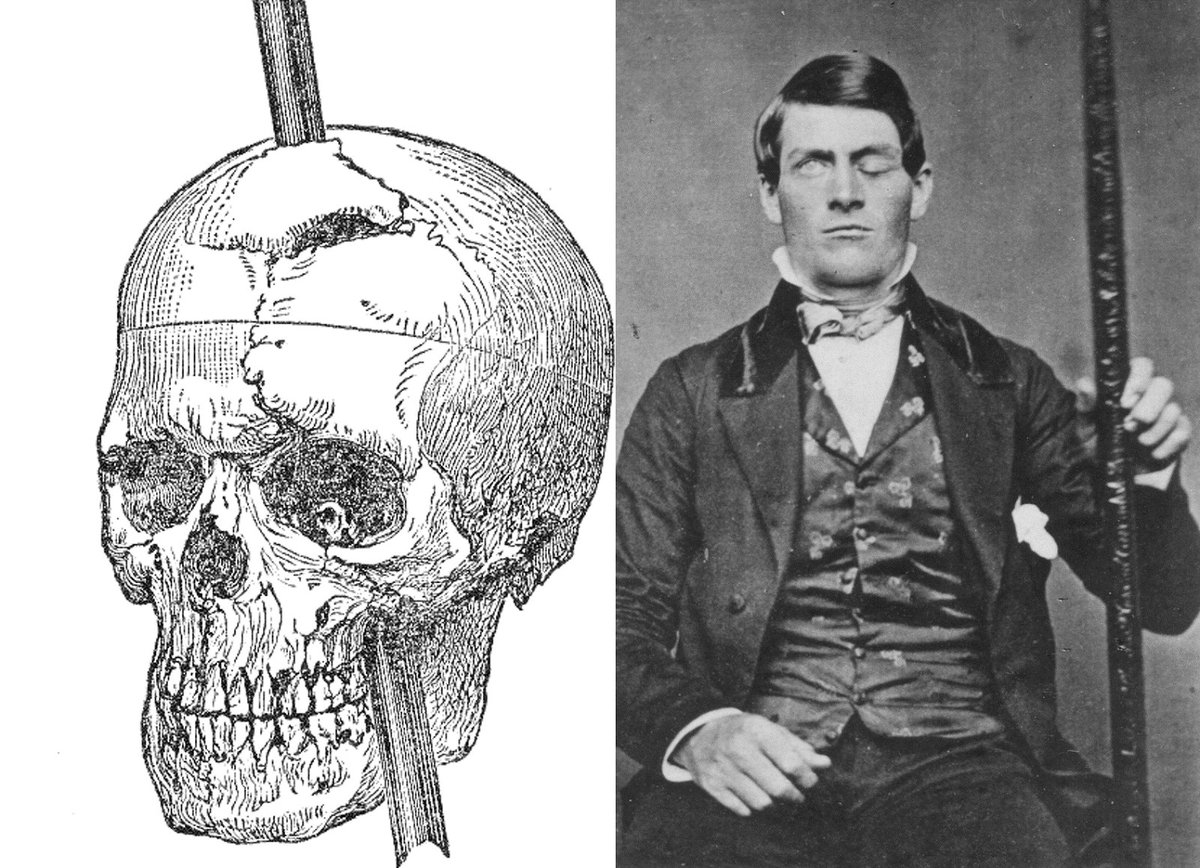 what does the case study of phineas gage teach us
