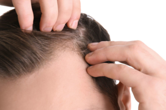alopecie-falacrofobia