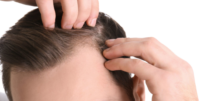 alopecie-falacrofobia